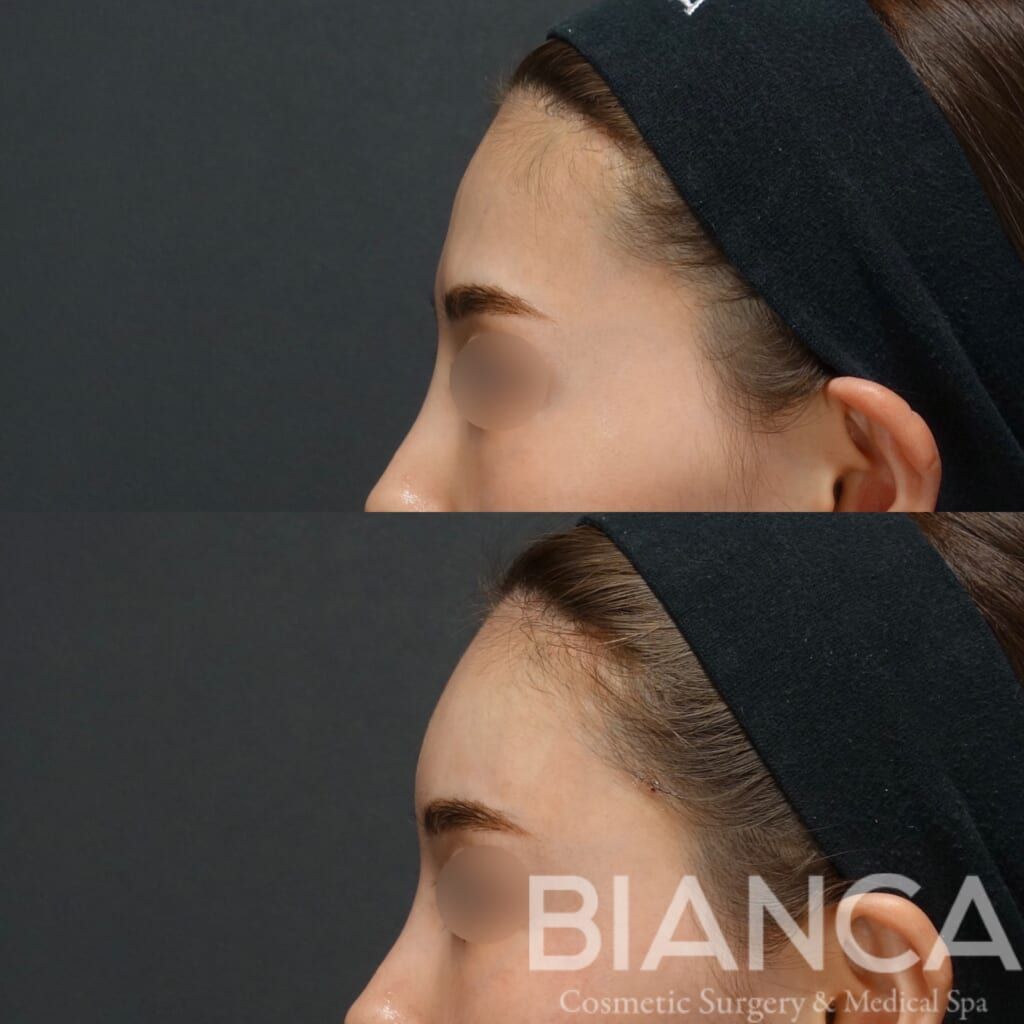Before and immediately after comparison of temple filler treatment, profile angle