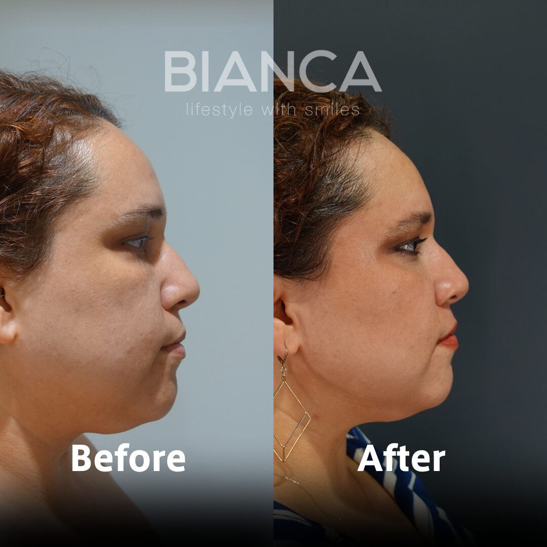 HIFU / ULTRAcel Zi®