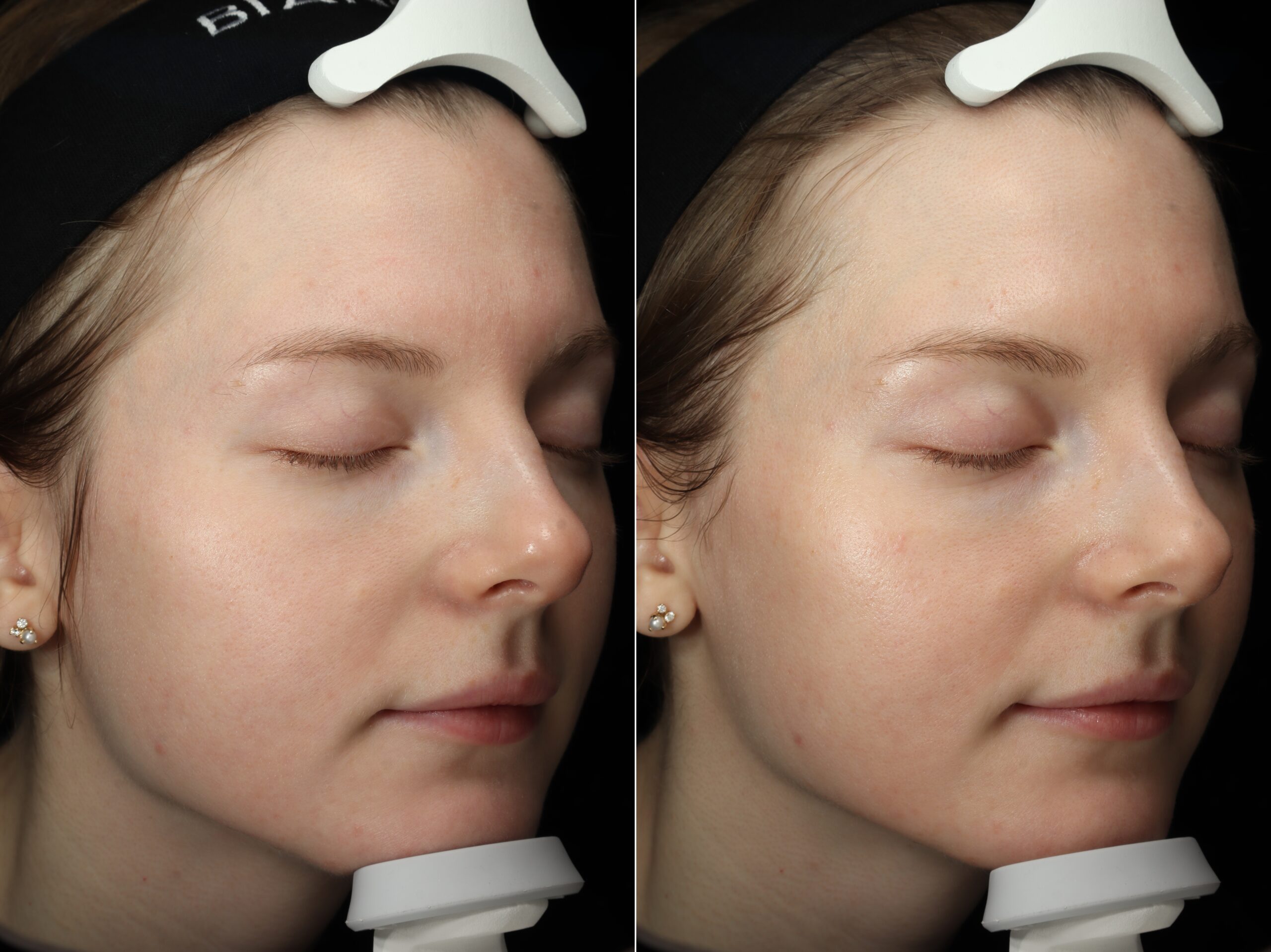 Skin Infusion (mesoporation)