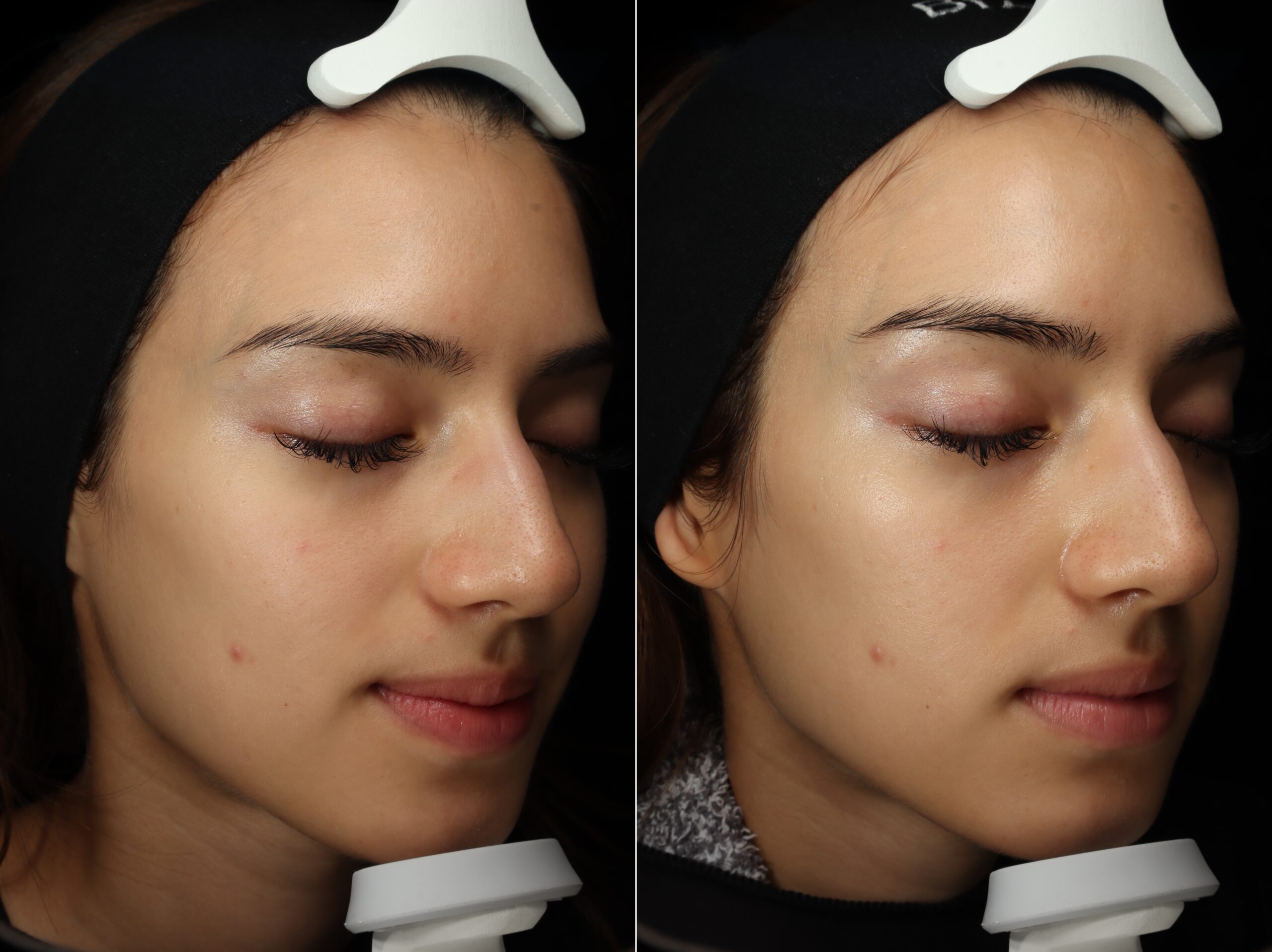 Skin Infusion (mesoporation)