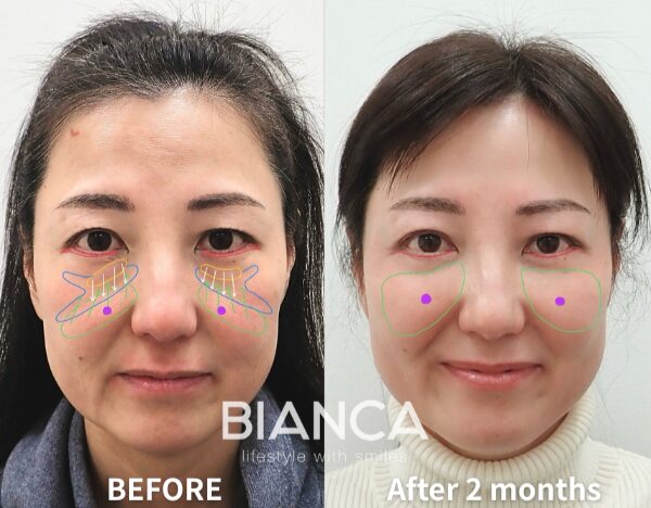 Mid Facelift