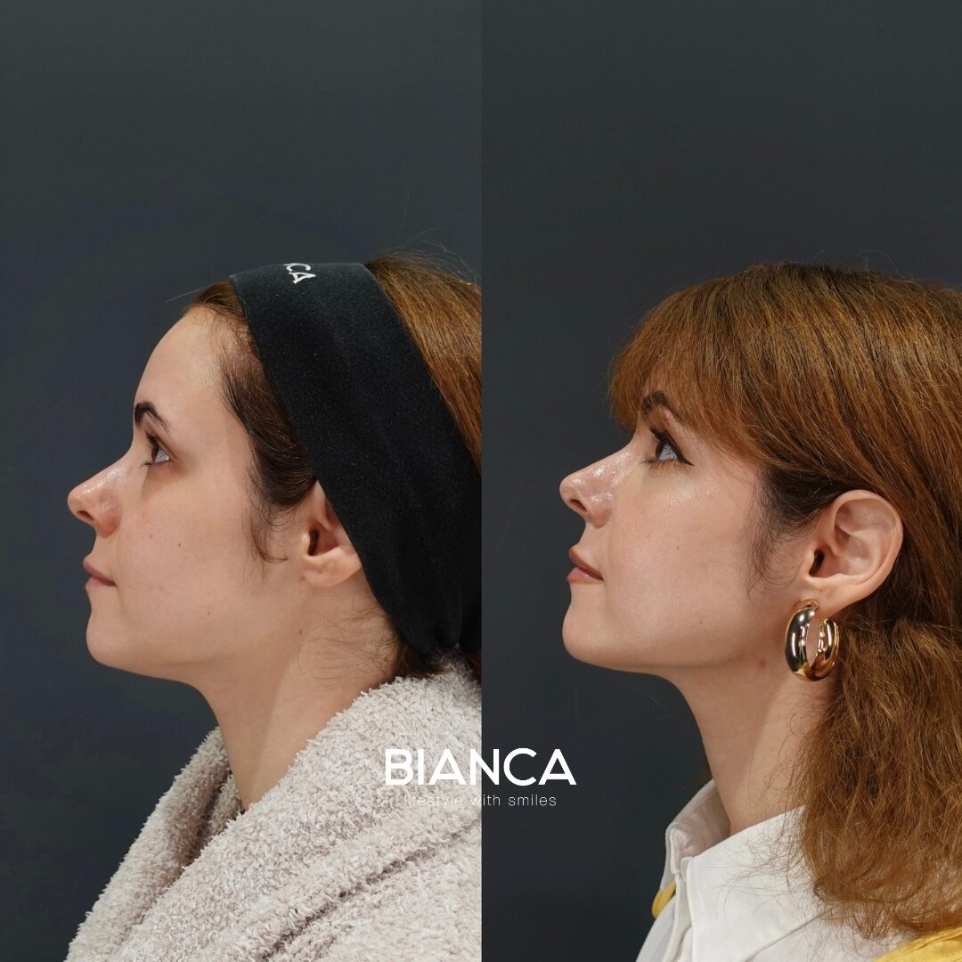 Vaser Liposuction (Face)
