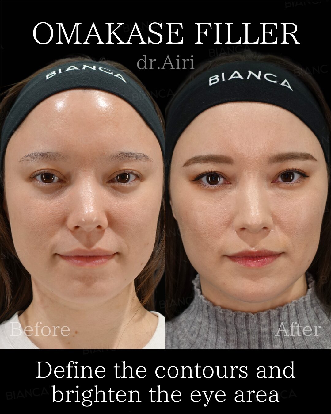 Filler / Hyaluronic acid injection