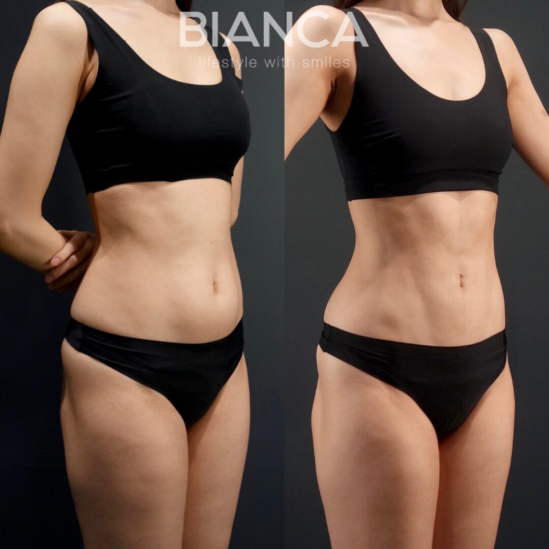 Abcracks (Abdominal Etching)