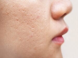 Close-up of acne scars and enlarged pores on a woman's cheek.