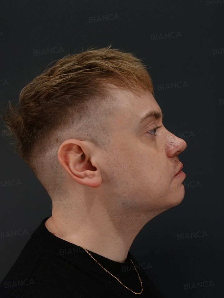 Side View After