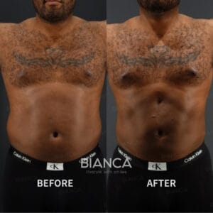 Left image: Before treatment / Right image: 1 month after Treatment details: VASER liposuction (abdominal etching / ab crack formation) Cost (This will be self-funded treatment): ¥1,210,000 (tax inc.) Risks / side effects: Lump, asymmetry, hematoma, irregularities, infection, etc.