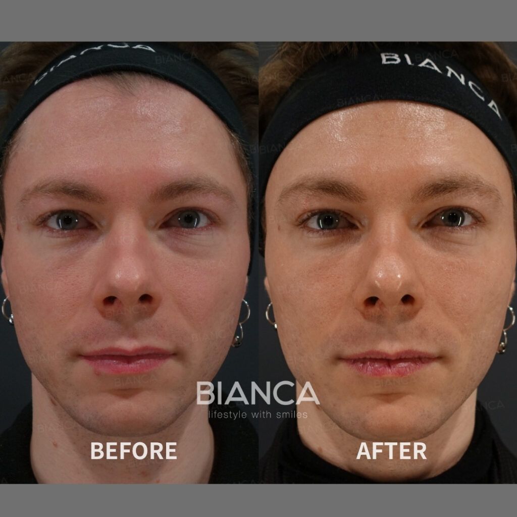 Juvelook Injection For Full Face