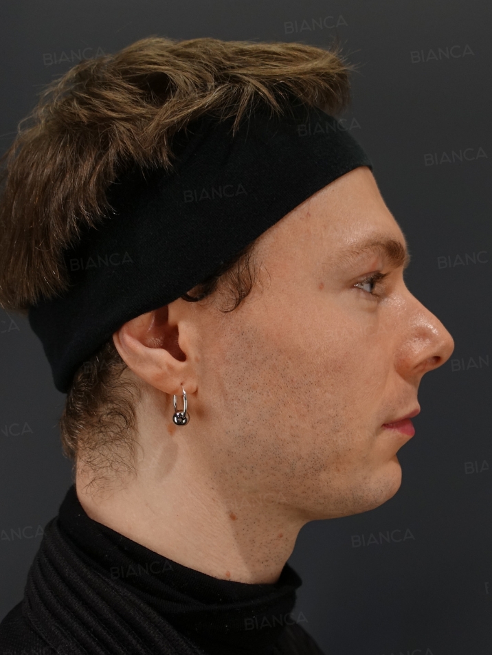 Side View After