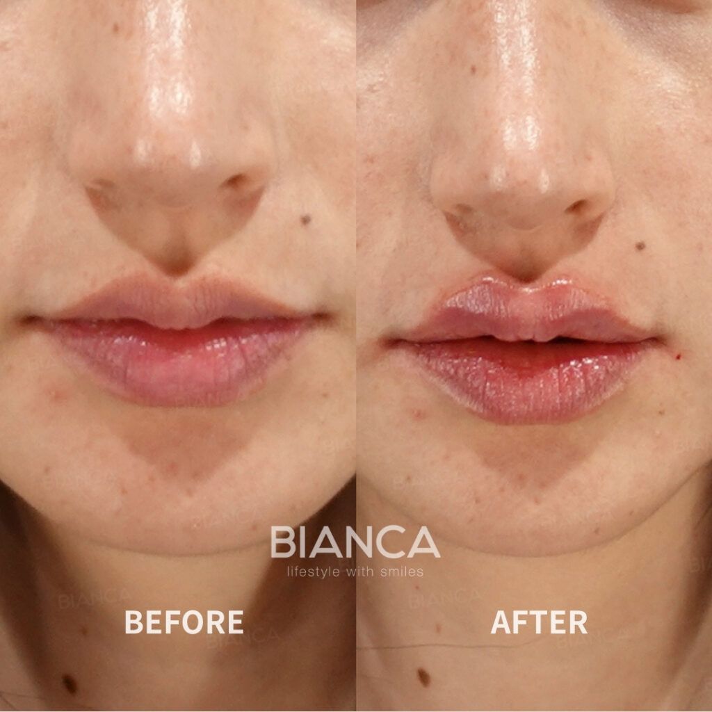 Left image: Before treatment / Right image: 2 weeks after Treatment details: Hyaluronic acid filler (lips), Juvederm VOLBELLA Cost (This will be self-funded treatment): ¥108,900 (tax inc.) Risks / side effects: Lump, asymmetry, hematoma, irregularities, infection, etc.
