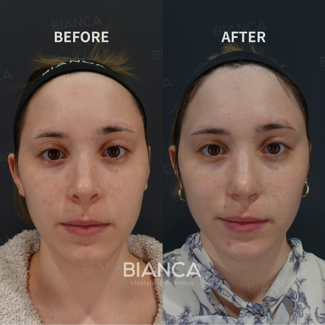 Nasal bone osteotomy、Nasal tip shaping 、Rhinoplasty <reduction of the nostril rim> (Skin + Ear Cartilage Transplantation