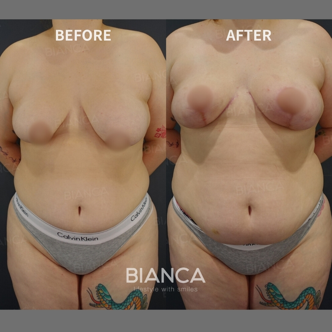 Breast List