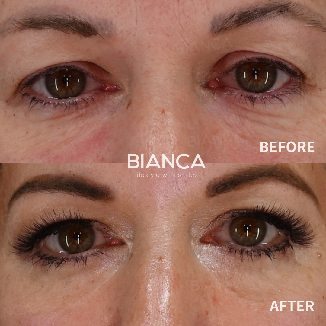 Upper Blepharoplasty / Uround Eye Morpheus 8