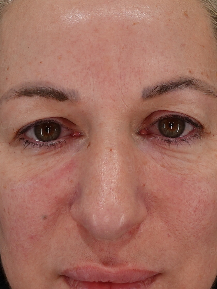 Front View Before