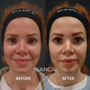 Before and after photo of pico laser spot treatment for full face.
