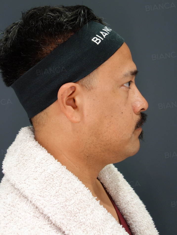Side View Before