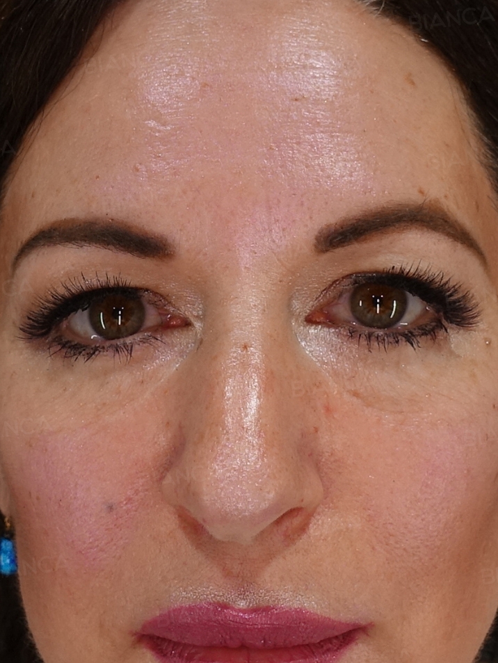 Front View After