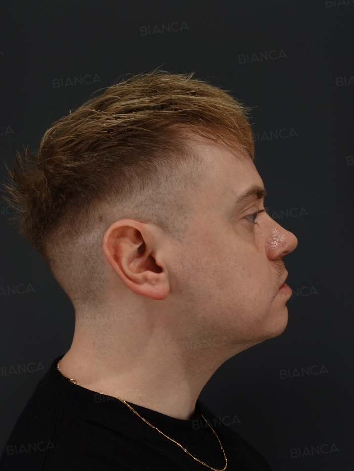 Side View Before