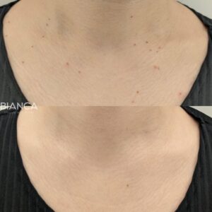 Professional Wart Removal in Japan at BIANCA CLINIC <br>Dr. Iwama