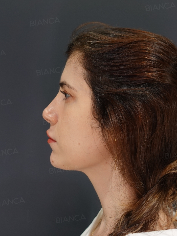 Side View After