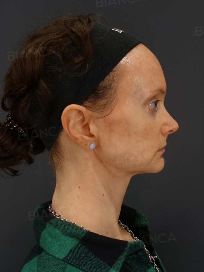 Side View After
