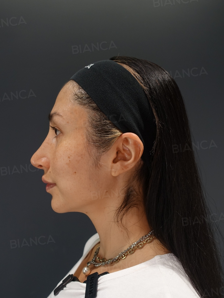 Side View Before