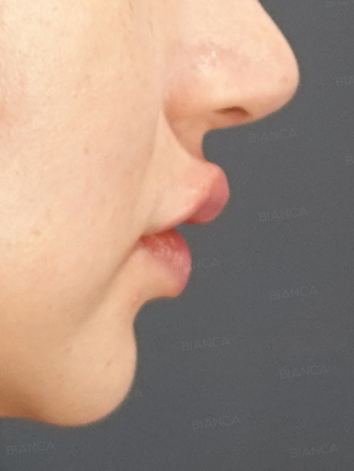 Side View After