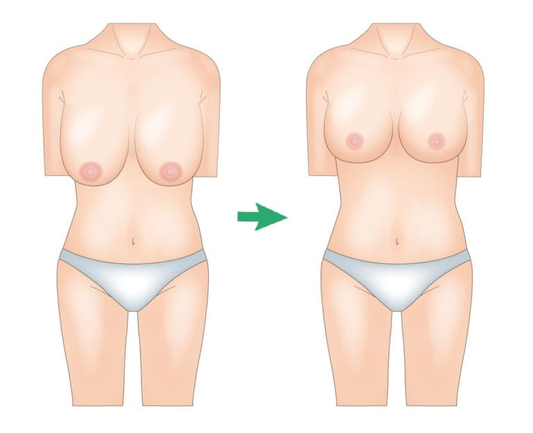 BREAST REDUCTION