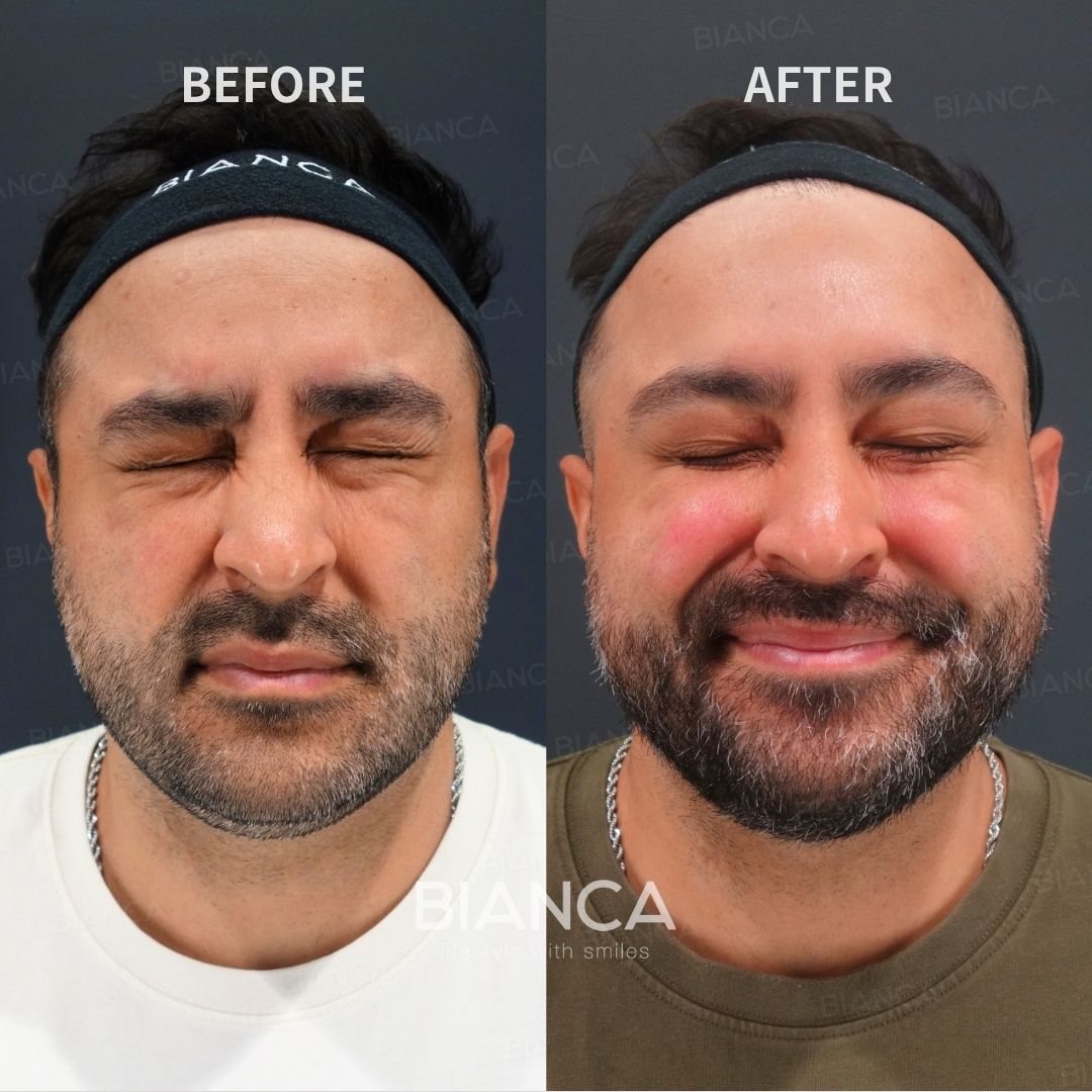 Botox Treatment Forehead Botox / Crow’s Feet Botox (Allergan Botox)