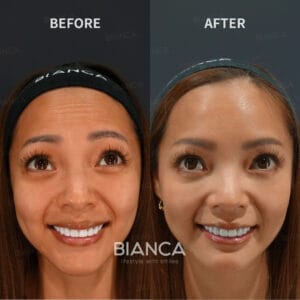 Botox Treatment Forehead Botox (Allergan Botox)