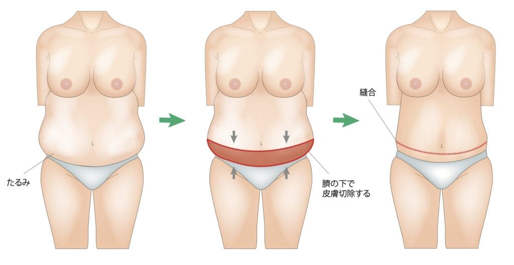 Tummy Tuck