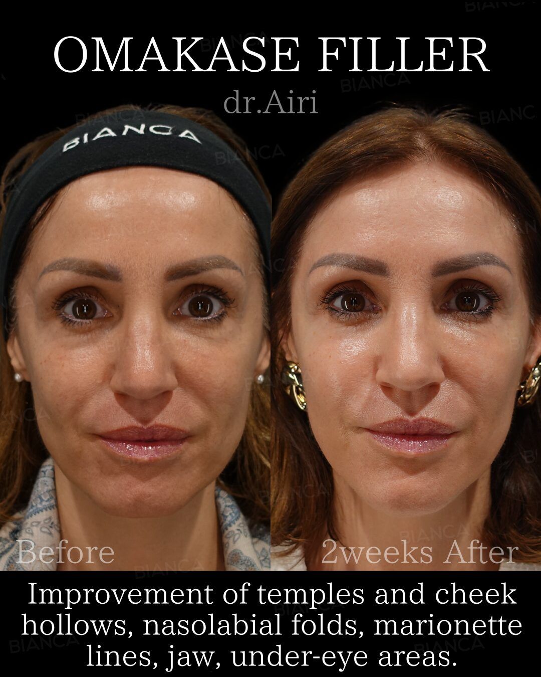 Fillers Under Eye Bags in Tokyo: A Gentle Guide from an English‑Speaking Aesthetic Surgery Expert