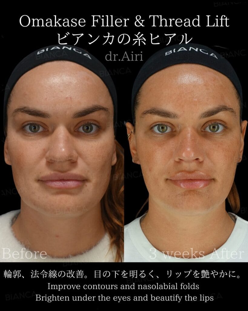 Fillers Juvederm Guide: Smooth, Natural Results in Tokyo