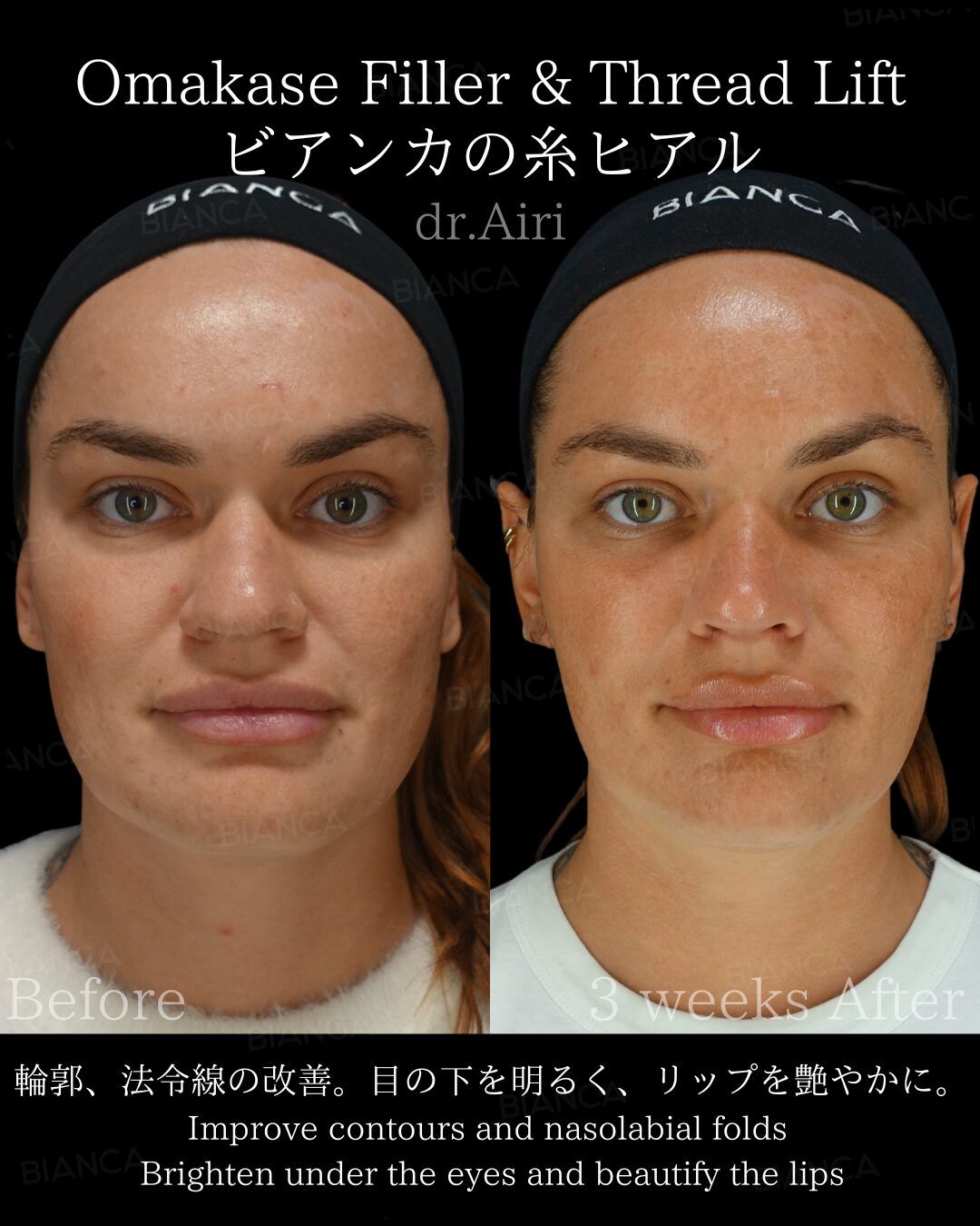 Masseter Botox in Japan Is Reinventing Aesthetic Surgery Practices Around the World