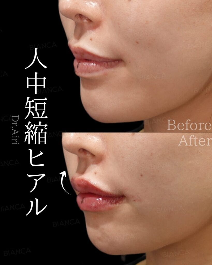 Lip Fillers Natural Look: Subtle, Balanced Results for International Clients in Tokyo