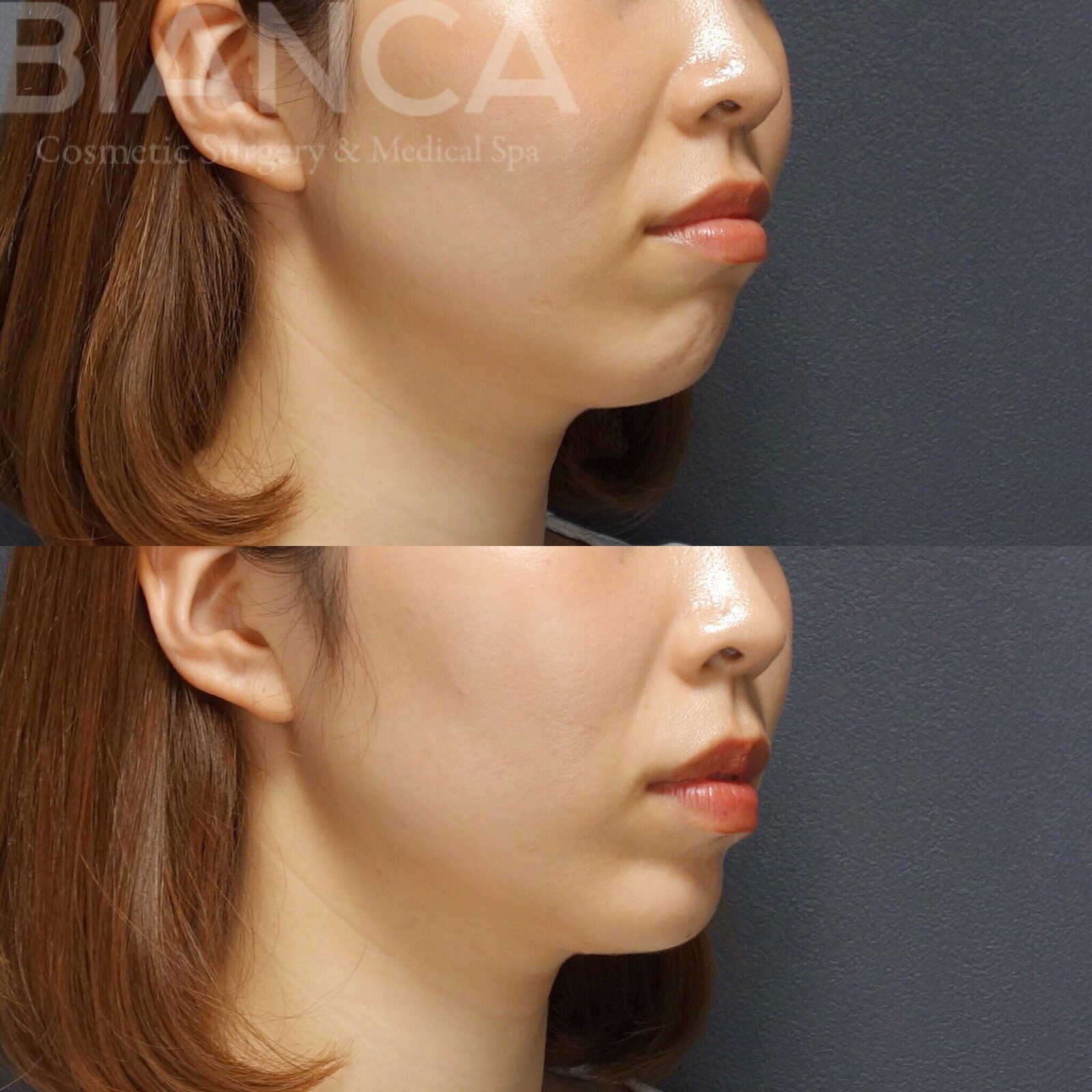 Botox Cost Guide: What to Expect in japan and Tokyo Across Medical Spa and Aesthetic Surgery Clinics