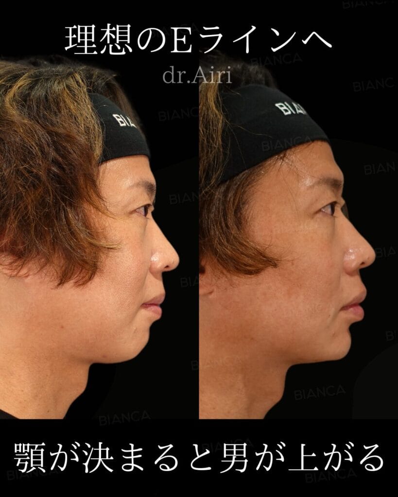 Natural Harmony with Fillers One Piece Treatment in Tokyo