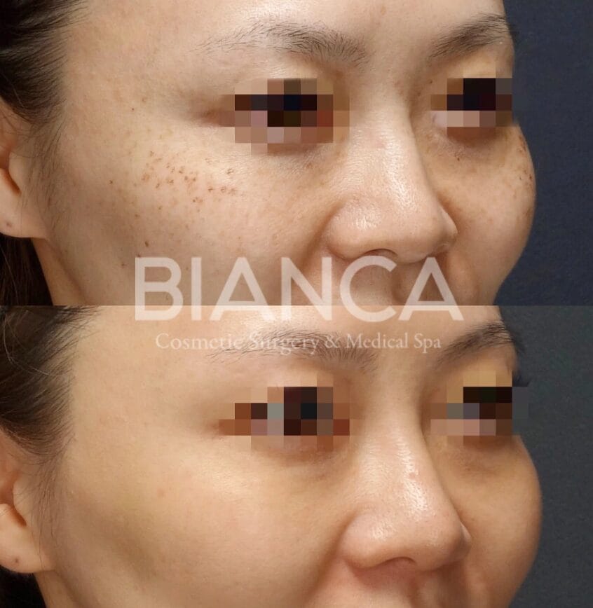 Laser Skin Treatment in Tokyo: A Guide to Choosing a Medical Spa Near Me