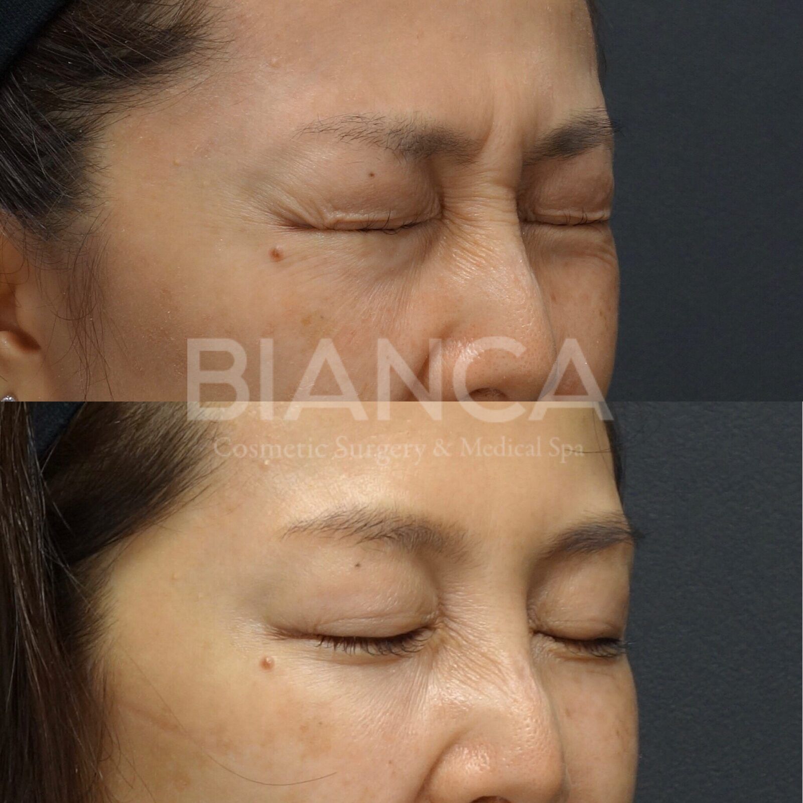 Botox on Smile Lines in Tokyo: Gentle, Natural Rejuvenation You Can Trust