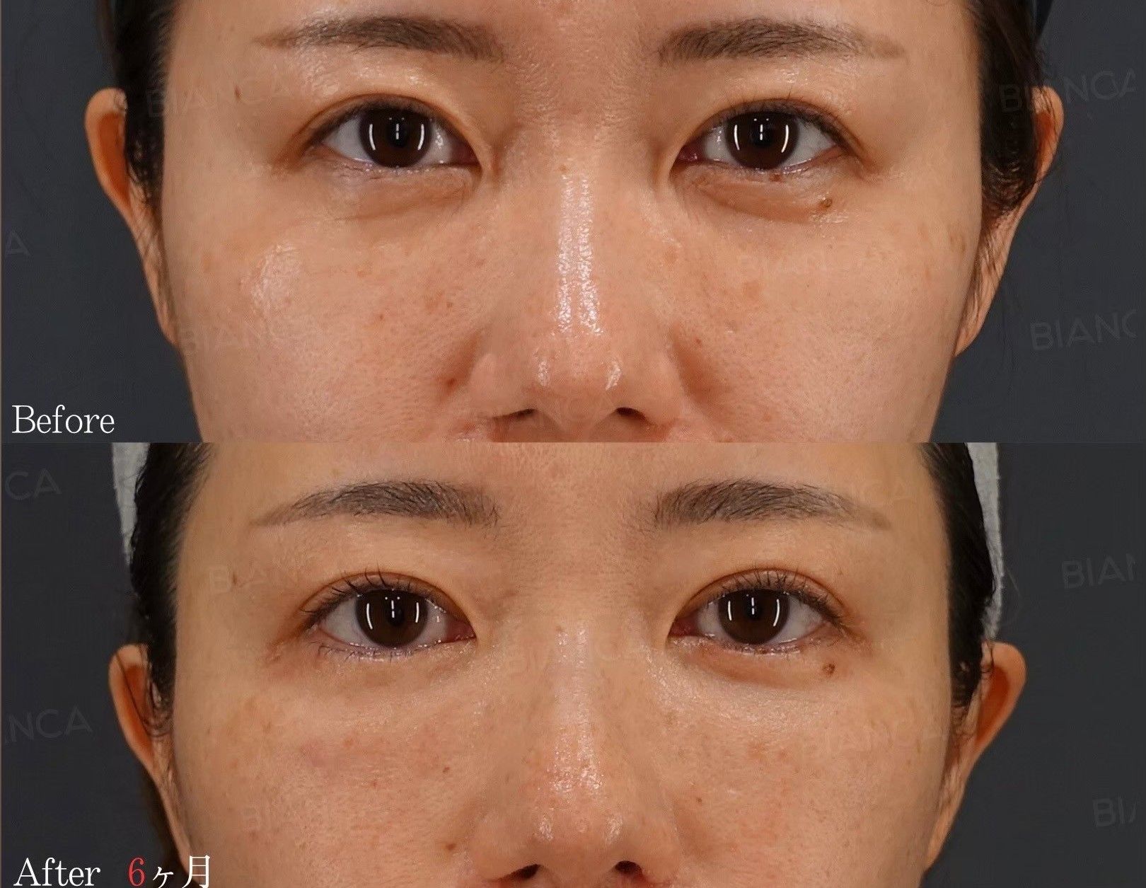Treatments for Under Eye Dark Circles : Comparing Surgical and Non Surgical options