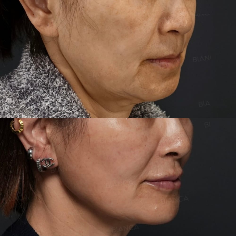 Cavitation and RF: Gentle Contouring, Tightening & English-Speaking Guidance at BIANCA CLINIC In Tokyo