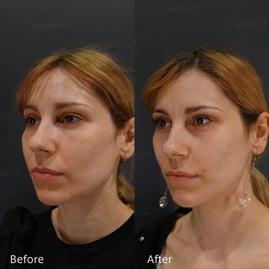Fillers for Smile Lines: A Tokyo Aesthetic Surgery Guide to Natural, Rested Results