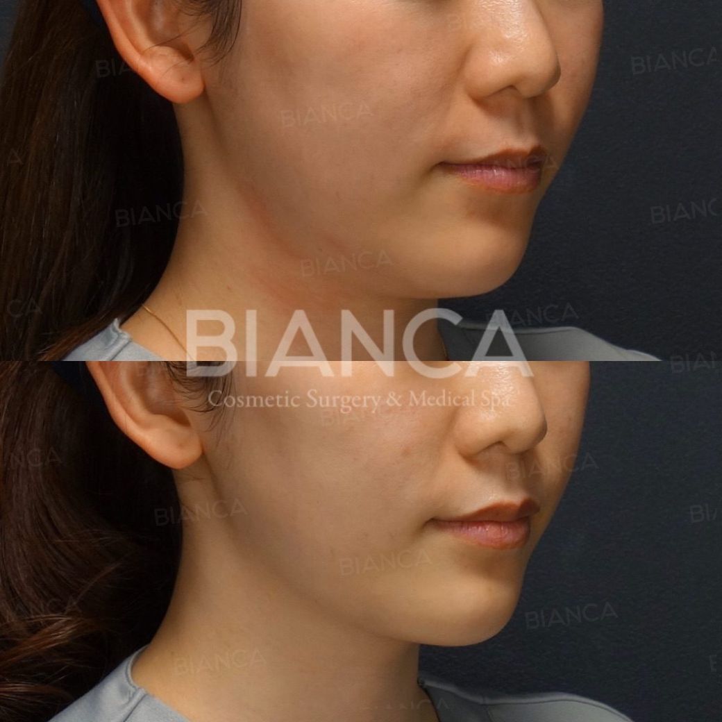 HIFU Treatment in Tokyo, in Japan: Expert, Gentle Skin Tightening at a Medical Spa Near Me