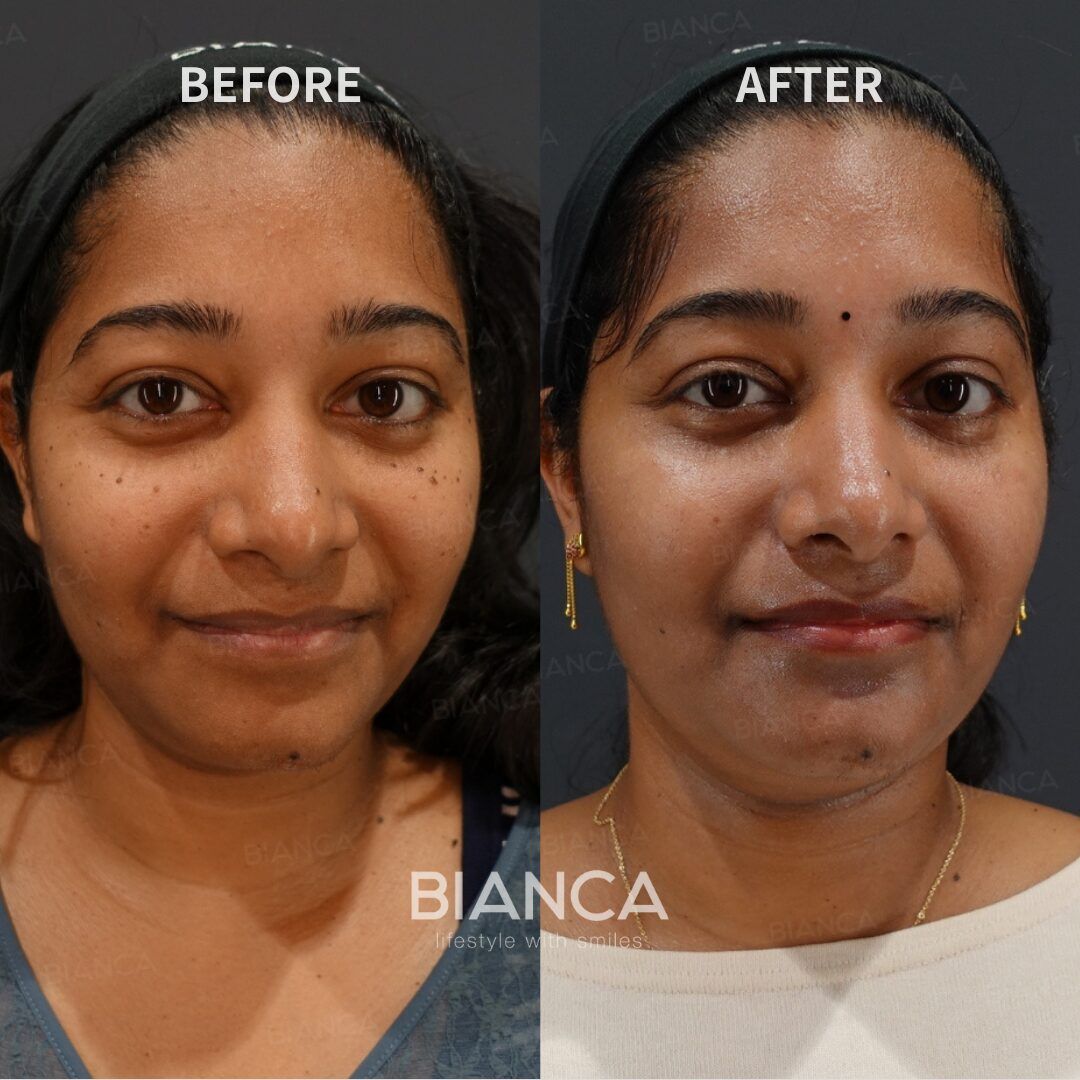 CO2 laser mole removal　（unlimited) BIANCA in Tokyo, Japan