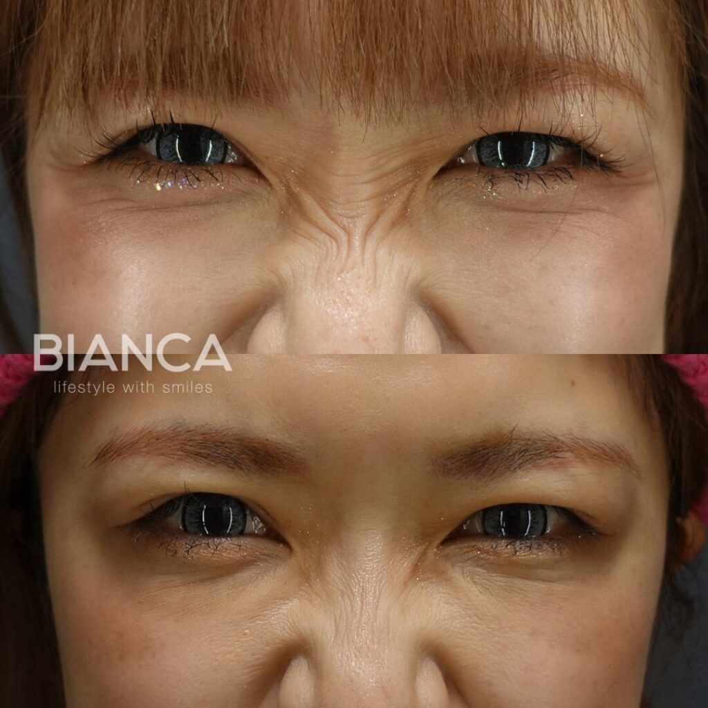 Botox Areas Explained: Your Friendly Guide to Natural Results in Tokyo, in japan