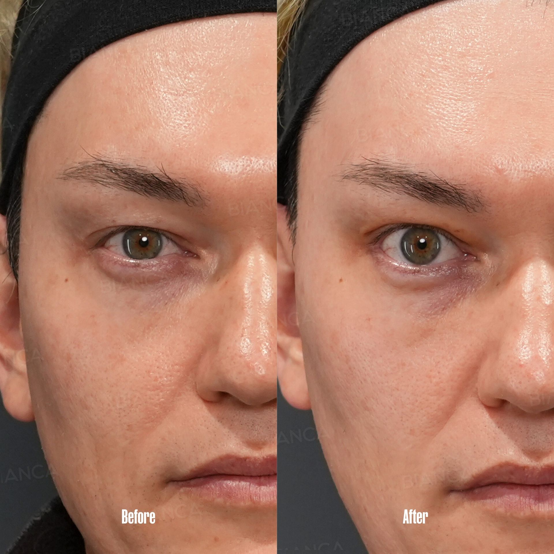 Hooded Eyes Uncovered: The Expert Treatment Available “Near Me” Around Tokyo