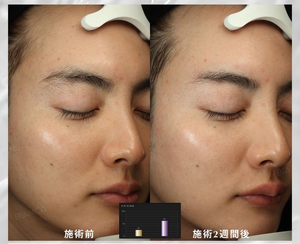 Glass Skin Treatment Near Me | Quick and Effect Care at BIANCA CLINIC in Tokyo