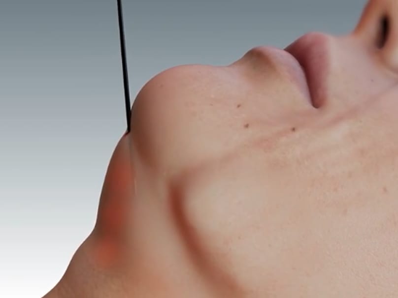 Quantum RF handpiece with cannula inserted into the jawline