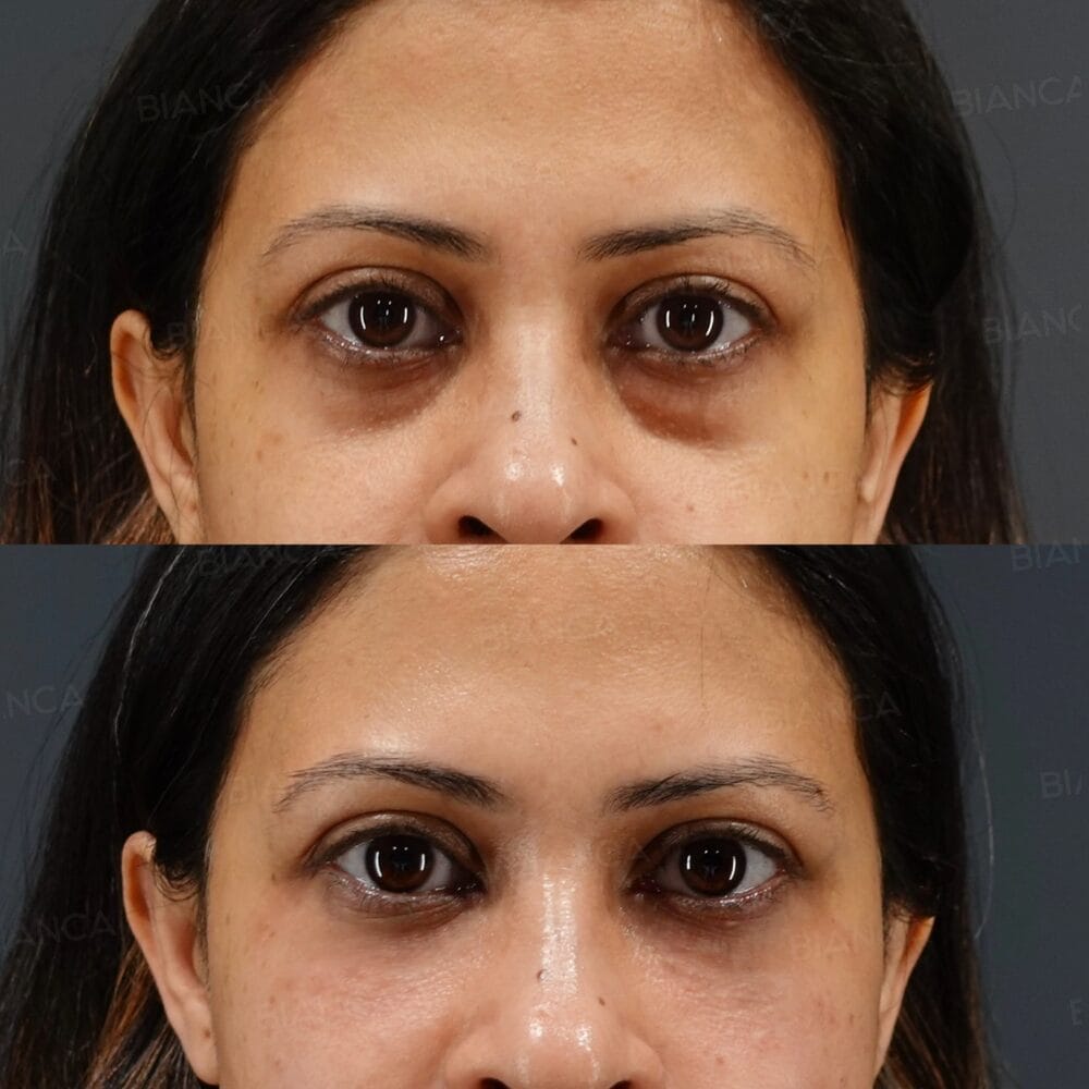 Eye Bag Removal in Tokyo: A Patient Guide to Plastic Surgery and Consultation