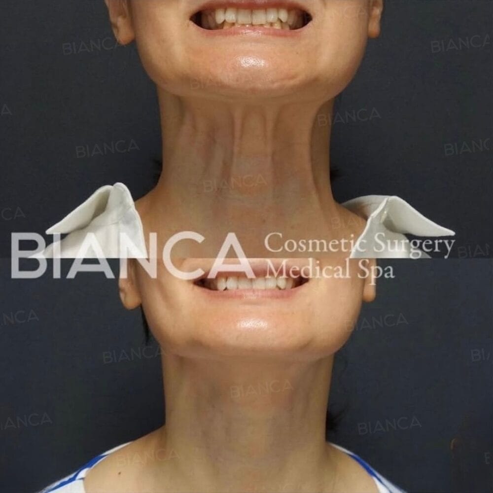 How to Get Rid of Neck Wrinkles in Tokyo: Home Care & Medical Spa Options